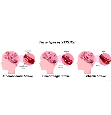 Stroke 1 copy