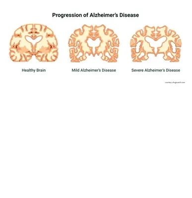Alzheimer Disease gallery 1