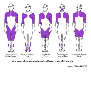 Muscular Dystrophy 5