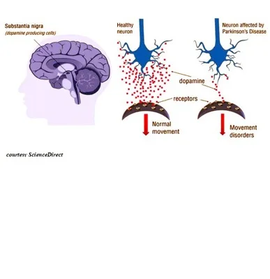 Parkinson Disease 4