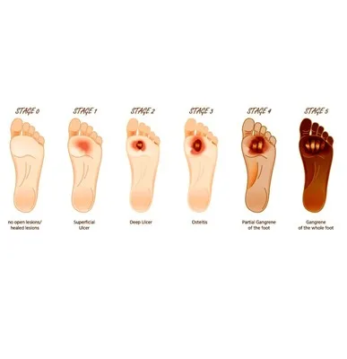 Diabetic Foot Ulcer 3